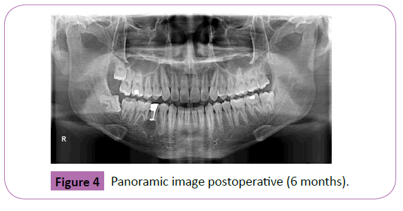 Transient Paresthesia after Surgical Removal of Embedded 